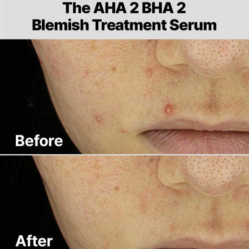 {COSRX} -  The AHA 2 BHA 2 Blemish Treatment Serum